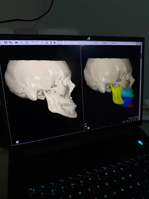 Cirurgia ortognática para correção facial em Itajaí