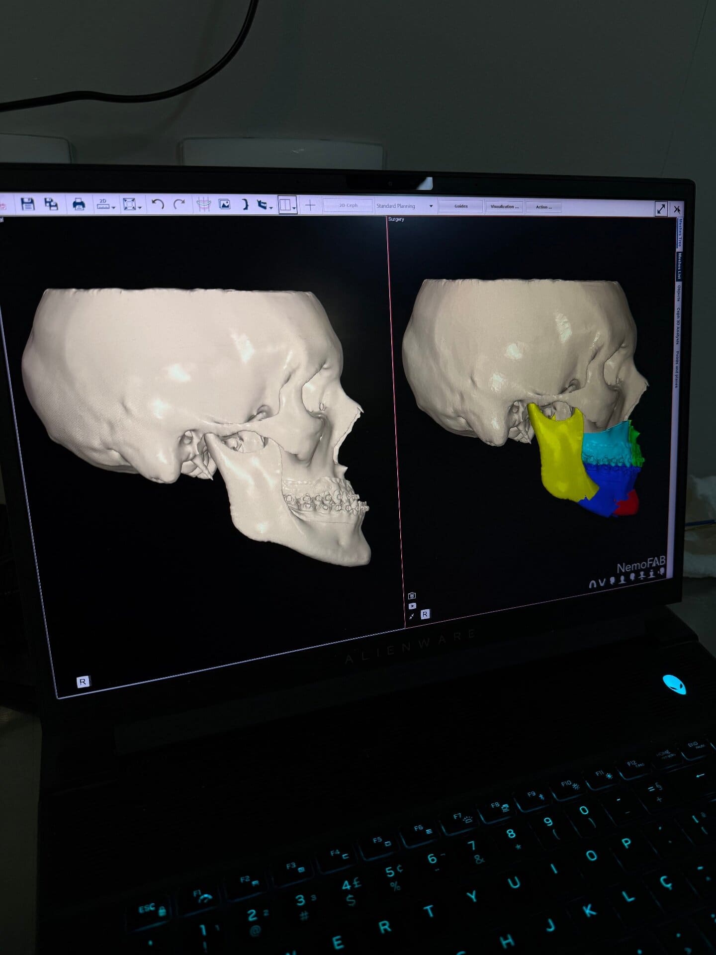 Cirurgia ortognática para correção facial em Itajaí