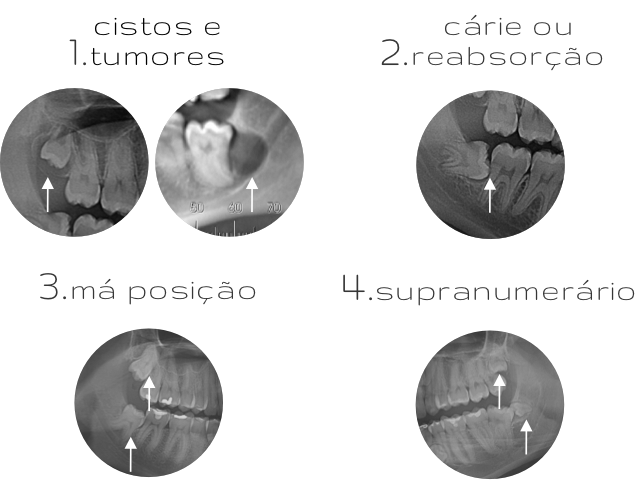 Imagens de radiografias de casos de sisos com cistos, tumores, cárie, reabsorção, má posição e dente supranumerário além do siso.