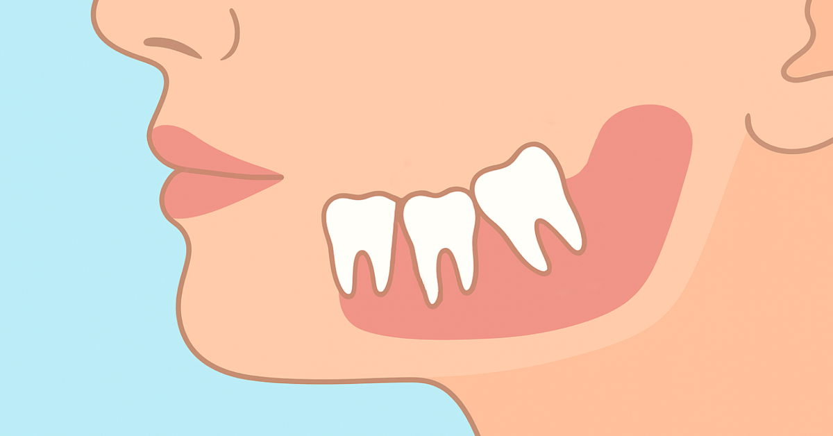 Desenho dos dentes do siso em um rosto feminino.